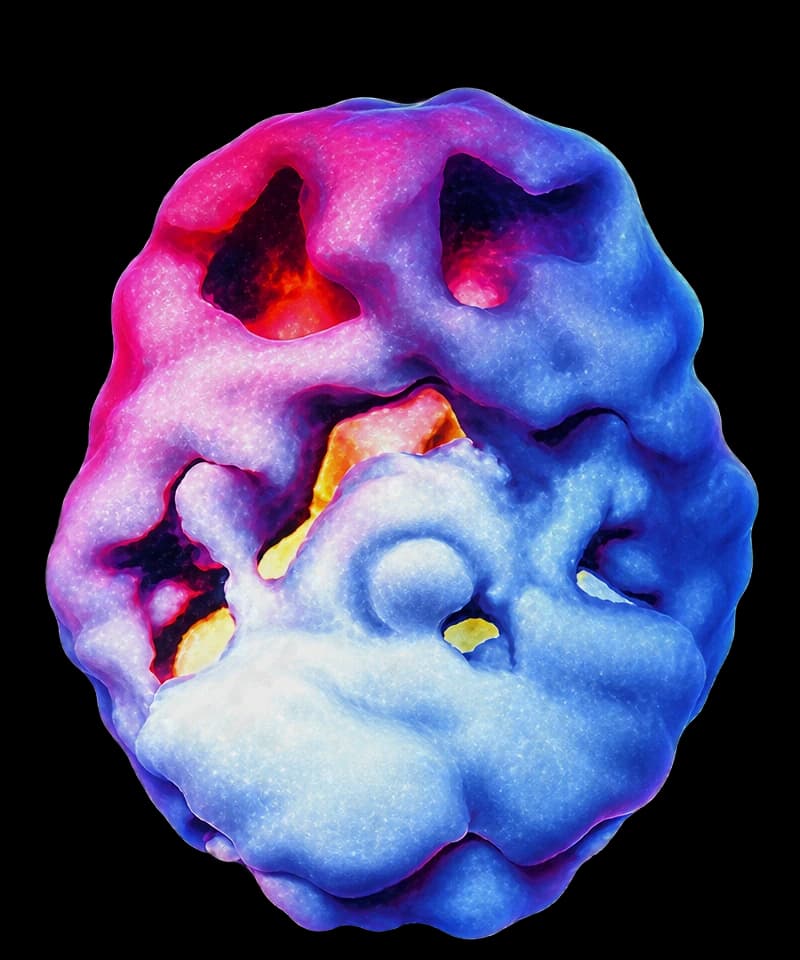 Scansione SPECT di un cervello sotto stress cronico, vista dall'alto: nella parte frontale compaiono ampie zone scure, senza flusso sanguigno.
